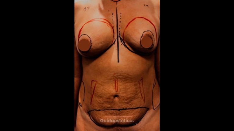 Liposcultura - Dott. Filippo Di Meglio
