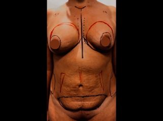 Liposcultura - Dott. Filippo Di Meglio