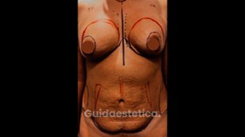Liposcultura - Dott. Filippo Di Meglio