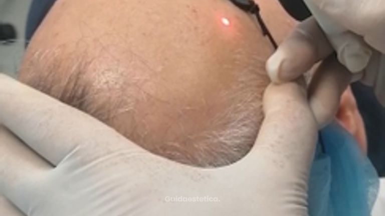 Laserterapia - Dott. Umberto Fama