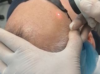 Laserterapia - Dott. Umberto Fama