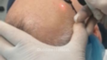 Laserterapia - Dott. Umberto Fama
