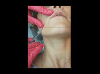 Filler