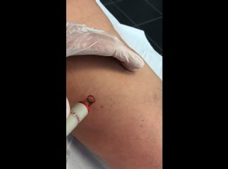 Vene varicose - Dott. Virgilio Medical Laser