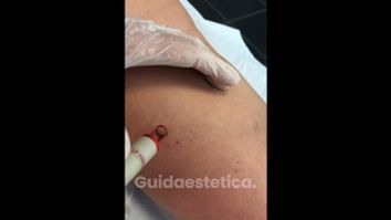 Vene varicose - Dott. Virgilio Medical Laser