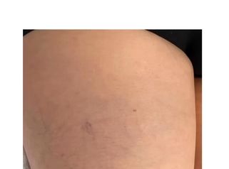 Dott. Giovanni Migliorini Teleangectasie alle gambe