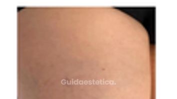 Dott. Giovanni Migliorini Teleangectasie alle gambe