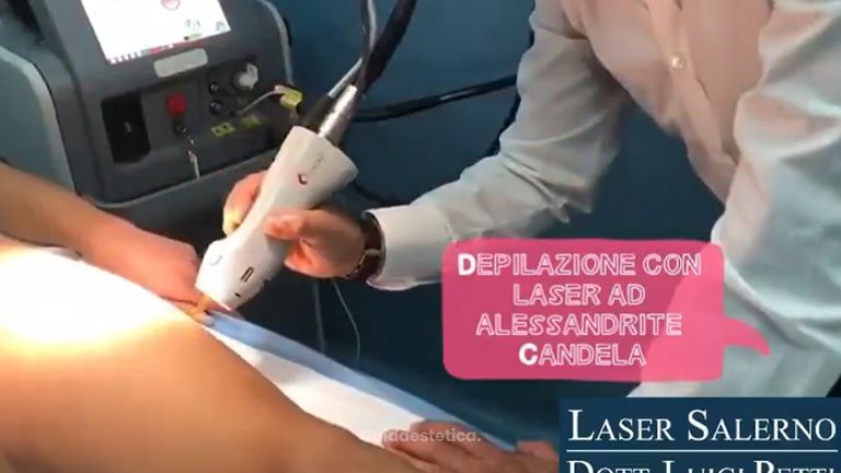 Depilazione laser