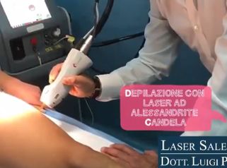 Depilazione laser