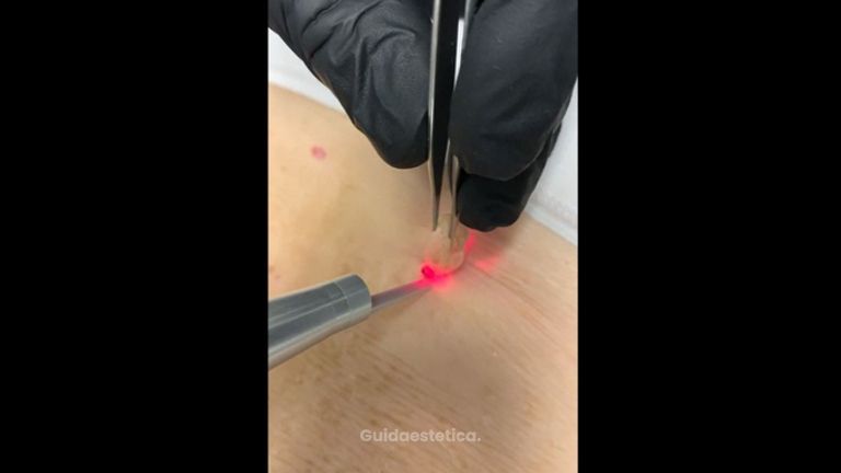 Verruche - Dott. Virgilio Medical Laser