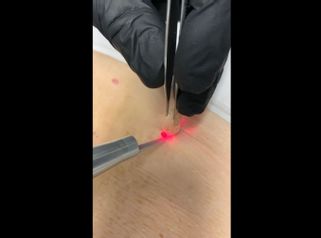 Verruche - Dott. Virgilio Medical Laser