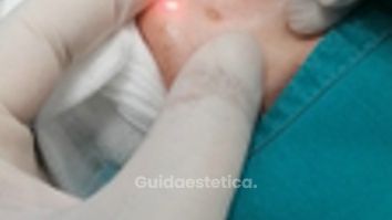 LASERTERAPIA - Dott. Umberto Fama