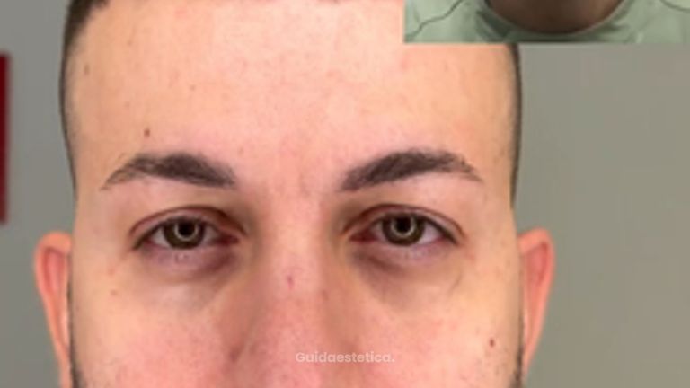 Dott.ssa Assmaà Abu-Higileh Risultato botulino uomo: meno rughe e viso più fresco
