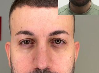 Dott.ssa Assmaà Abu-Higileh Risultato botulino uomo: meno rughe e viso più fresco