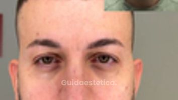 Dott.ssa Assmaà Abu-Higileh Risultato botulino uomo: meno rughe e viso più fresco