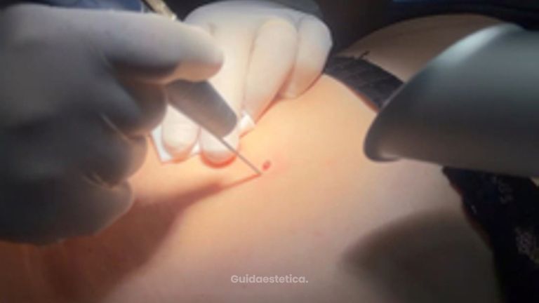 Skin Laser Clinic Rimozione nei con Laser CO2 che vaporizza la neoformazione