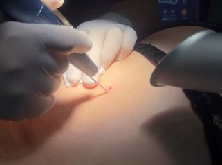 Skin Laser Clinic Rimozione nei con Laser CO2 che vaporizza la neoformazione