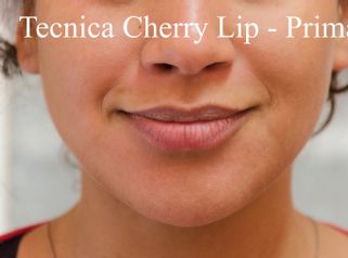 Dott. Santoro Maurizio - Tecnica "Cherry Lip" e Ridefinizione e Reidratazione delle Labbra