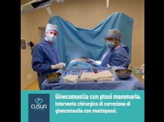 Ginecomastia - Clisur- Clinical & Surgery