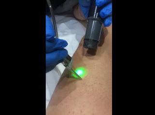 Trattamento di laser epilatorio Alexandrite - Dott.ssa Cornelia Florea