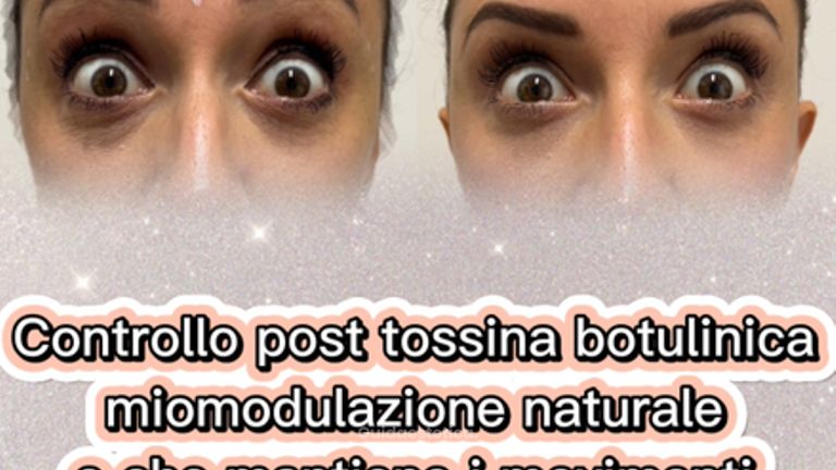 Dott.ssa Iole Cucinotto Trattamento con tossina botulinica per rughe d’espressione