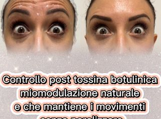 Dott.ssa Iole Cucinotto Trattamento con tossina botulinica per rughe d’espressione