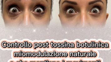 Dott.ssa Iole Cucinotto Trattamento con tossina botulinica per rughe d’espressione
