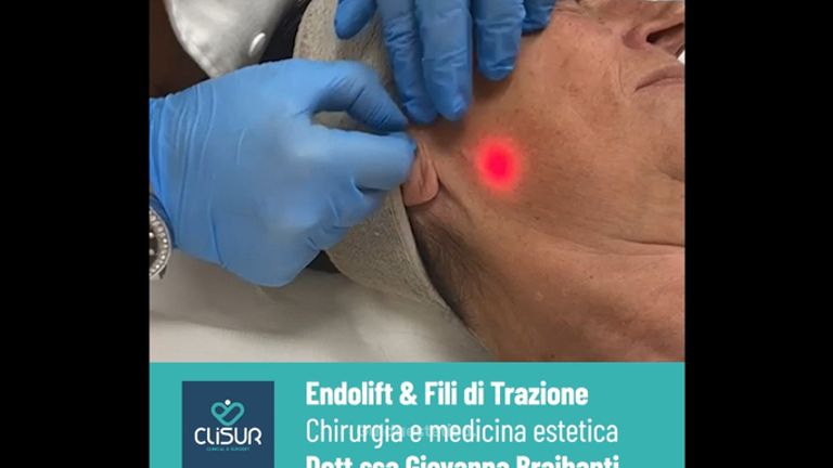 Endolift - Clisur- Clinical & Surgery
