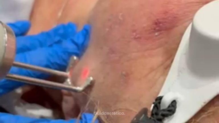 Dott.ssa Cornelia Florea Rimozione macchie cutanee con laser  Meta descripción