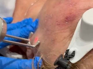 Dott.ssa Cornelia Florea Rimozione macchie cutanee con laser  Meta descripción