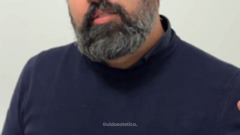 Dott. Antonio Vernillo Visita dopo mastoplastica: Alessia racconta il risultato a un mese