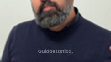 Dott. Antonio Vernillo Visita dopo mastoplastica: Alessia racconta il risultato a un mese
