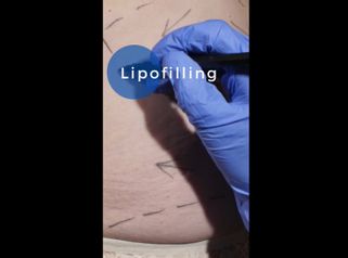 Lipofilling - Equipe Estetica