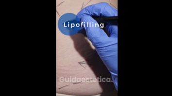 Lipofilling - Equipe Estetica