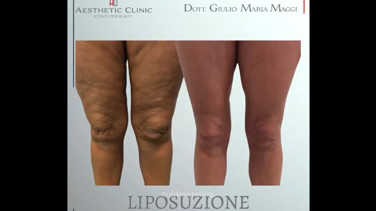 Liposuzione - Aesthetic Clinic del Dott. Giulio Maria Maggi