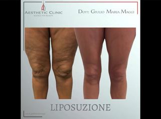 Liposuzione - Aesthetic Clinic del Dott. Giulio Maria Maggi