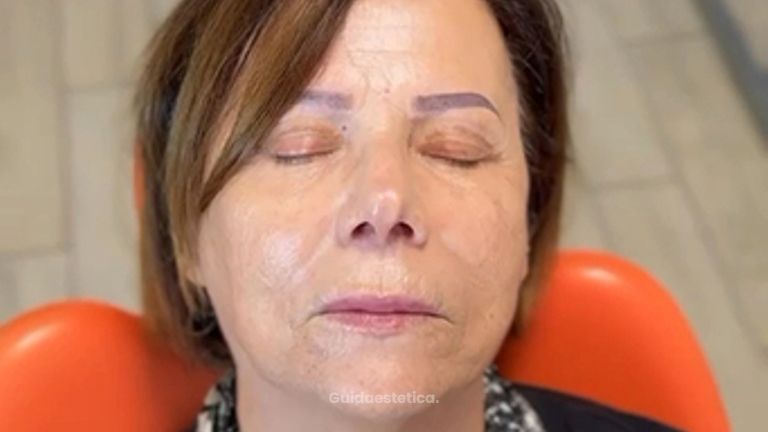 Dott.ssa Sara Carinci Effetto prima e dopo Filler labbra