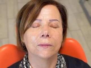 Dott.ssa Sara Carinci Effetto prima e dopo Filler labbra