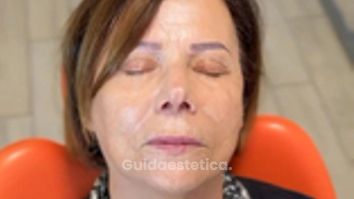 Dott.ssa Sara Carinci Effetto prima e dopo Filler labbra