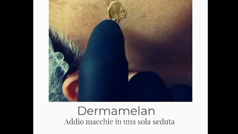 Medicina Estetica Cotilli: Macchie della pelle