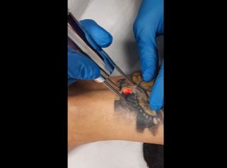 Rimozione tatuaggi - Tuamedica
