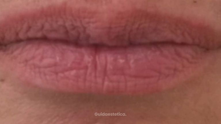 Dott.ssa Irene Pistis Filler Labbra
