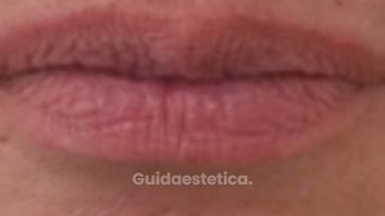 Dott.ssa Irene Pistis Filler Labbra