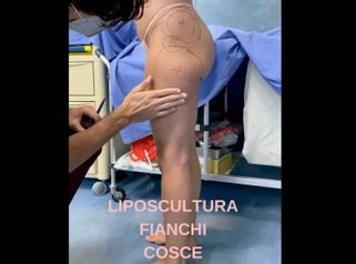 Liposcultura - Dr. Luca Zattoni