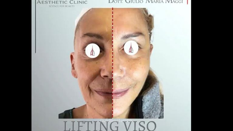 Lifting viso - Aesthetic Clinic del Dott. Giulio Maria Maggi