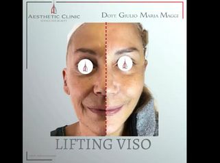 Lifting viso - Aesthetic Clinic del Dott. Giulio Maria Maggi
