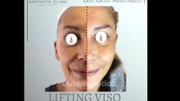 Lifting viso - Aesthetic Clinic del Dott. Giulio Maria Maggi