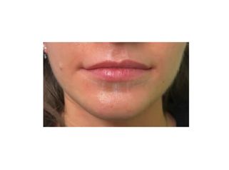 Dott. Giovanni Migliorini Trattamento Filler Labbra