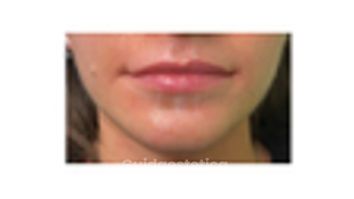 Dott. Giovanni Migliorini Trattamento Filler Labbra