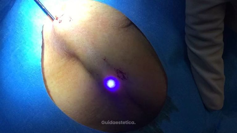 Lifting non chirurgico con il laser